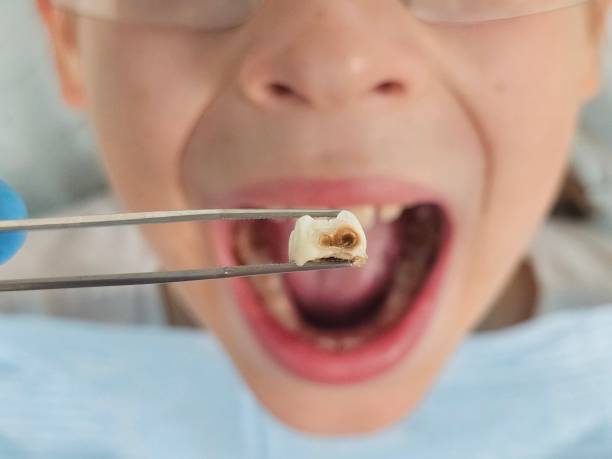 Best Emergency Tooth Extraction in Centerville, IN